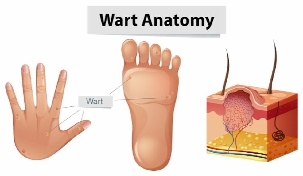 Erfolgreiche Entfernung von Warzen samt Wurzel mit Removio