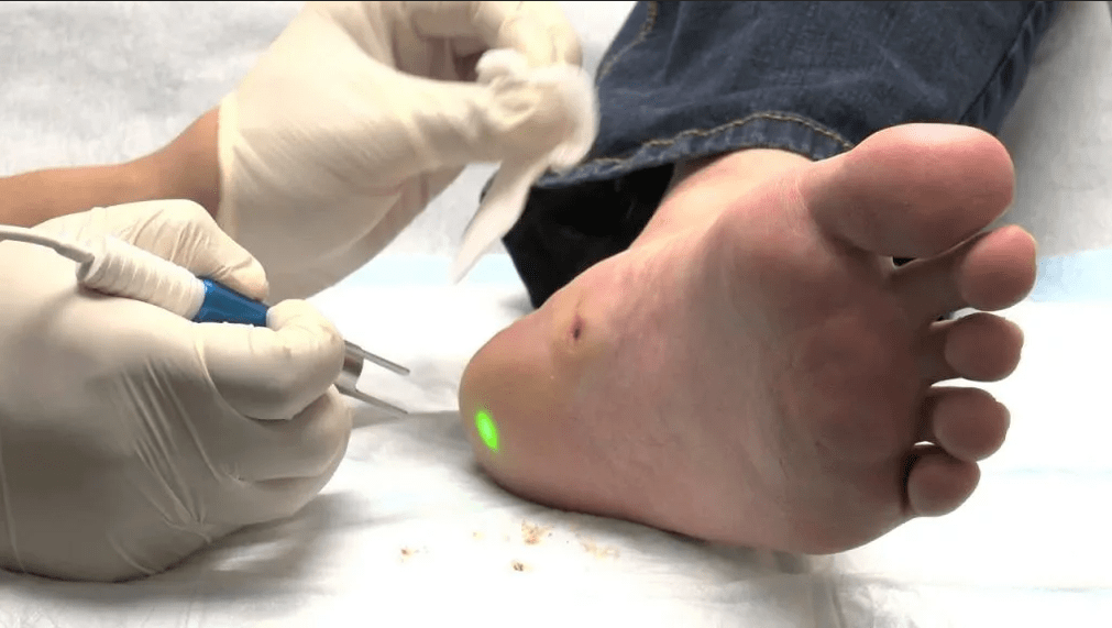 Behandlung von Plantarwarzen