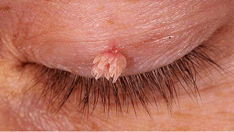 Papilloma
