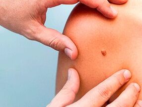 Gründe für das Auftreten von Papillomen am Körper