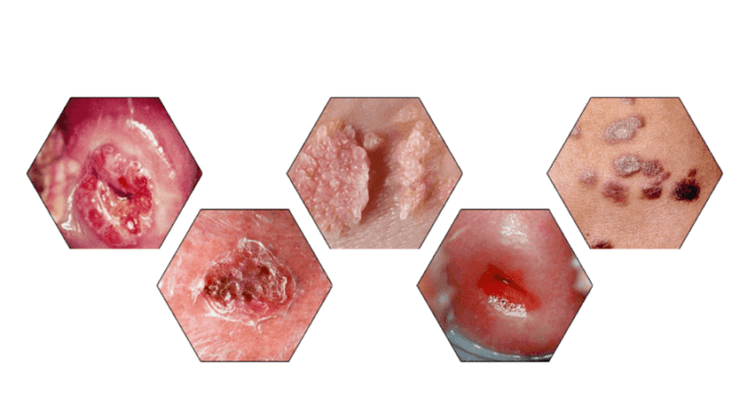 Warum sind Papillome gefährlich