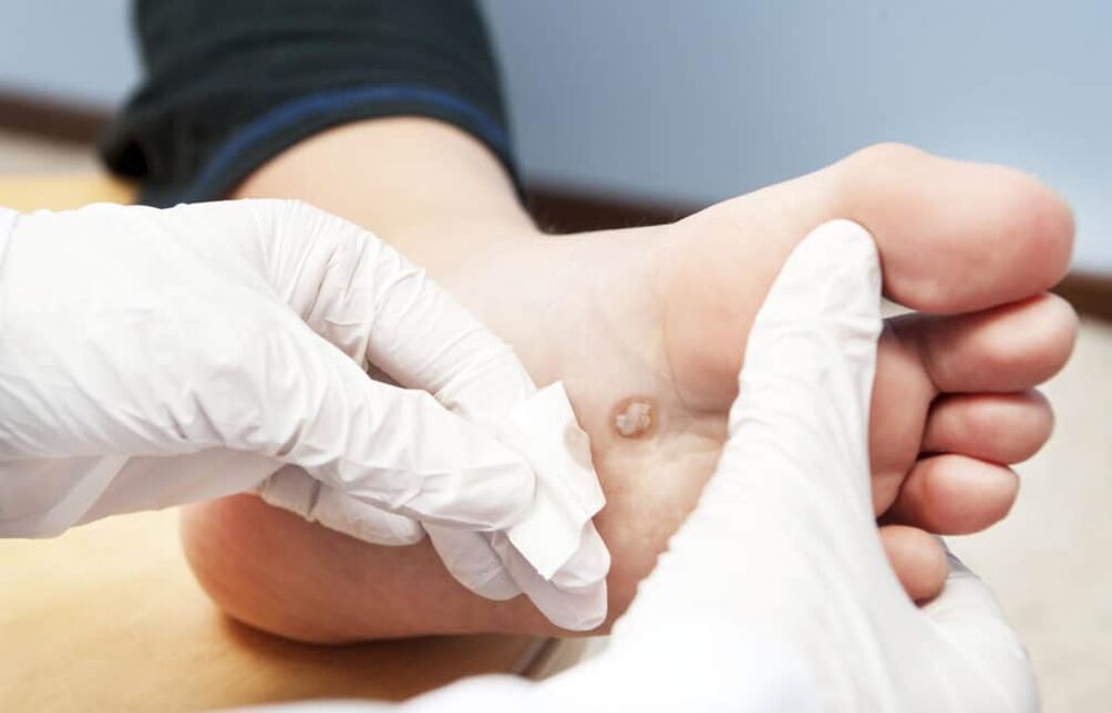 Warum treten Warzen am Körper auf