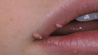 Papillome auf den Lippen